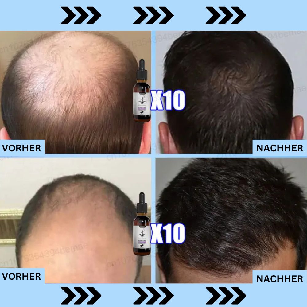 ADENOSIN Haarwachstumsserum | Schnelle Behandlung von Haarausfall bei erblich bedingter und seborrhoischer Alopezie